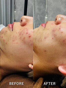 ルーク(Luke)/ニキビケア