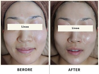 リノア(Linoa)/before/after