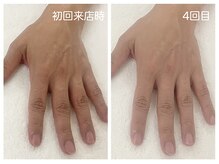 キレイテ 福岡天神店/乾燥と関節の黒ずみのお悩み