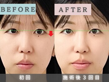 エルシンメトリー矯正院(ailesシンメトリー矯正院)/３回目　目の左右差　症例写真