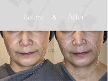 アイシス(AIsis)/【LDM/50代】顎周り/ほうれい線