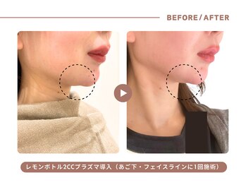 イエス マイサロン(yes My Salon)/レモンボトル施術例