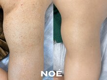 ノエ 新宿(NOE)の雰囲気（広々とした完全個室で、安心して施術を受けていただけます。）