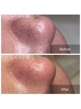 ユカリス(Yu.charis)/毛穴/モンロー式 before→after