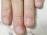 ◆深爪◆トラブル爪、爪の悩みの緩和を目指す爪育成