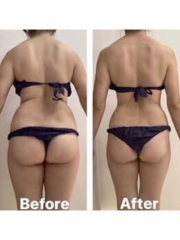 ワイグレイス(Y.GRACE)/ヴィーナスディーバ（4D痩身）