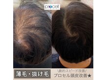 ワンブルーム(OneBloom)の雰囲気（健康的に頭皮を整えられる！圧倒的効果★【プロセル頭皮改善】）