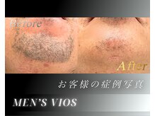 ヴァイオス 新宿店(VIOS)の雰囲気（【◆お客様のヒゲ脱毛の症例写真】［Before］→［After］）