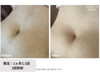 ニコ(Nico)/おなか脱毛