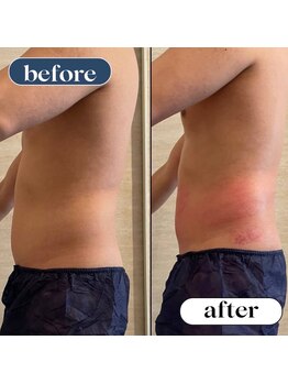 オーロラ(Aurora)/痩身ダイエットコースの２回目