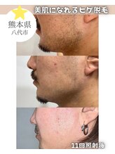 エスプラス エヌプラス(S+/N+)/ビフォアフ