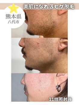 エスプラス エヌプラス(S+/N+)/ビフォアフ