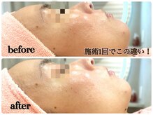 シルク(Cilk)/乱れたお肌90日間集中ケア