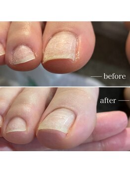 角質ケアができるサロン