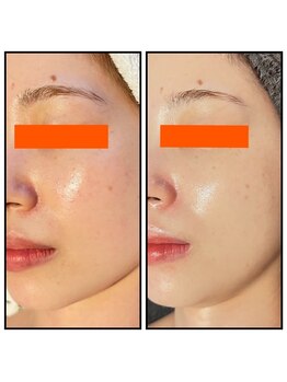 ピュアグレース 自由が丘/肌荒れが3ヶ月で解決☆