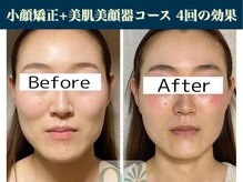 キュープ 表参道店(Qpu)/たった4回でここまで変わります