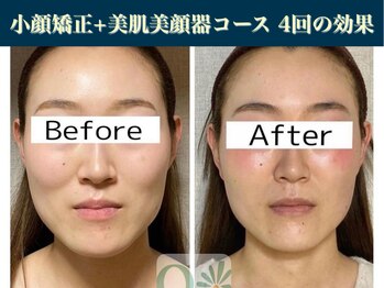 キュープ 表参道店(Qpu)/たった4回でここまで変わります