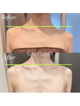 ルノン(Lunon)/ブライダルエステ