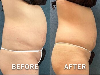 ビーホープ(B.hope)/30代産後モニター様6回目