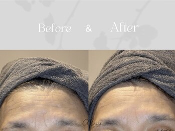 アイシス(AIsis)/【LDM/50代】おでこ&眉間のシワ