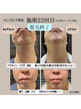 モーイエンチャーム(mooi en charme)/ヒゲ脱毛