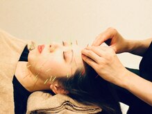 クマノミ美容鍼灸 川口院(KUMANOMI美容鍼灸)/ ぐっとリフトUPし小顔が定着！