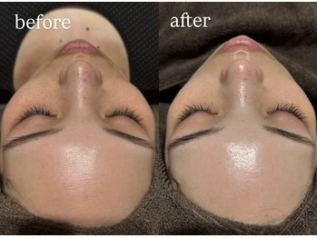 ビビ(Vivi)/シミケア！！！！