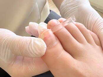 ルポ(REPOS)の写真/【ご新規様限定★巻き爪補正1箇所¥4400~】自分ではなかなか難しい巻き爪ケアはプロにお任せください！
