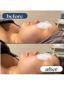 オーロラ(Aurora)/サブスク　フェイシャル　1回目