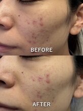 ルーク(Luke)/ニキビケア