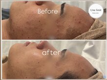 アンリミット 恵比寿店(Unelimit)/ハーブピーリングBefore→after