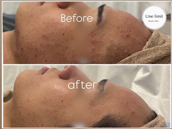 アンリミット 恵比寿店(Unelimit)/ハーブピーリングBefore→after