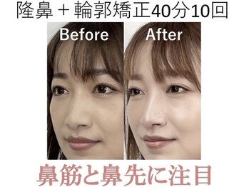 ラプリ 梅田店(Raplit)/隆鼻＋輪郭矯正40分10回