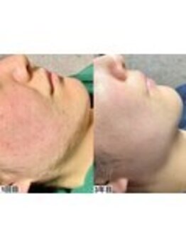 アンドミー 鹿児島中山(&me)/ ハーブピーリング【肌質改善】