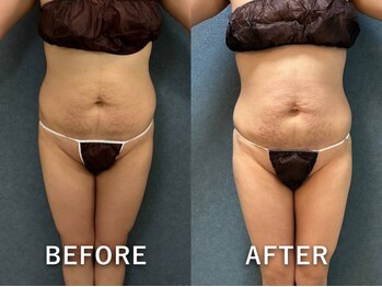 ビーホープ(B.hope)/30代産後モニター様6回目