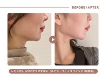 イエス マイサロン(yes My Salon)/レモンボトル施術例