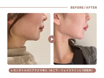 イエス マイサロン(yes My Salon)/レモンボトル施術例