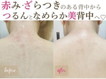 ソワンドビジュー(soin de bijew)/背中の剥けないハーブピーリング