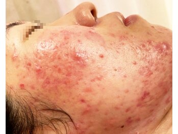 メレ(mele)の写真/【つくばで本気の肌質改善】ニキビケア・敏感肌も整う低刺激ピーリングで理想の素肌へ導く♪