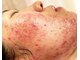 メレ(mele)の写真/【つくばで本気の肌質改善】ニキビケア・敏感肌も整う低刺激ピーリングで理想の素肌へ導く♪