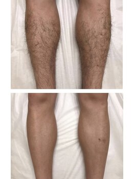 フリーダム(Freedom)/【脱毛前後写真】