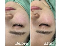 モイ(moi.)/◆マイクロニードルピーリング◆