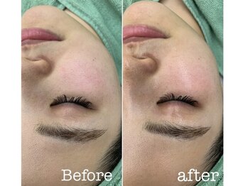 モイ(moi.)/◆マイクロニードルピーリング◆