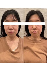 長寿鍼灸院 長寿整骨院/美容鍼100本の効果★（1回目）