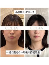 セリア(CELIA)/小顔矯正/小顔//面長/エラ張り