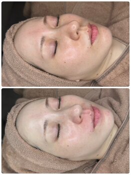 ワクワクフェイス 横浜店(WAKUWAKU FACE)/韓国最新美容ララピール/横浜駅