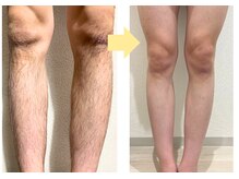 セルフダック いわき小名浜店(SELFDUCK)/◇すね毛脱毛のBeforeAfter！