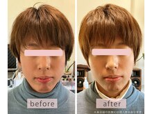 いとう鍼灸整体院 代官山恵比寿/美容鍼ビフォーアフター