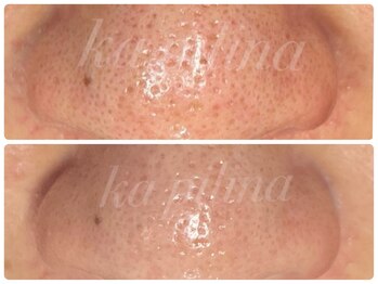 カピリナ(ka pilina)/何をしても繰り返えす毛穴たち！