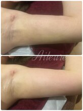 エルール トータルビューティ(Aileure total beauty)/術後ケア　二の腕